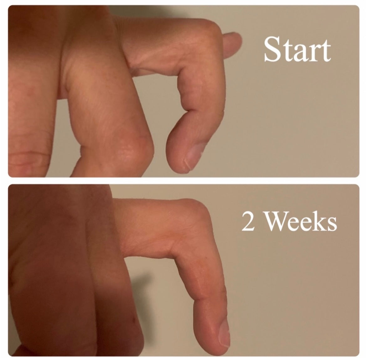 Finger Pivot Orthosis